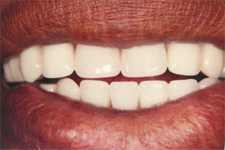 Dentures - After 1