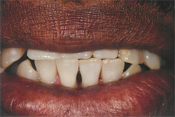 Dentures - Before 1